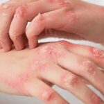 Eczedone Explained: How It Works and What You Need to Know